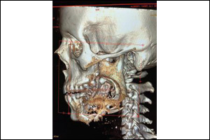 3d Printed Jaw, A Life Changer for Saudi Cancer Patient